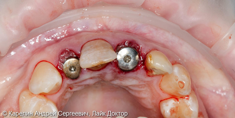 Эстетическая реабилитация фронтального участка верхней челюсти с помощью имплантатов - фото №6