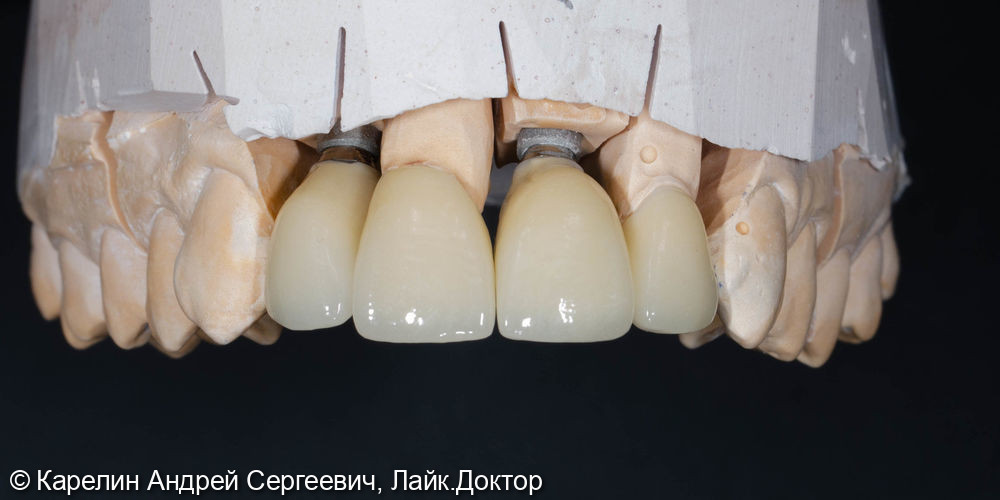 Эстетическая реабилитация фронтального участка верхней челюсти с помощью имплантатов - фото №10