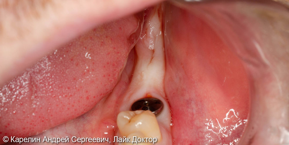 Восстановление отсутствующих зубов в 3 секторе с помощью имплантатов - фото №1