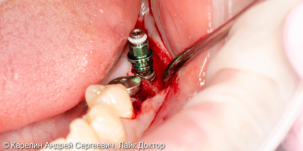 Восстановление отсутствующих зубов в 3 секторе с помощью имплантатов - фото №2