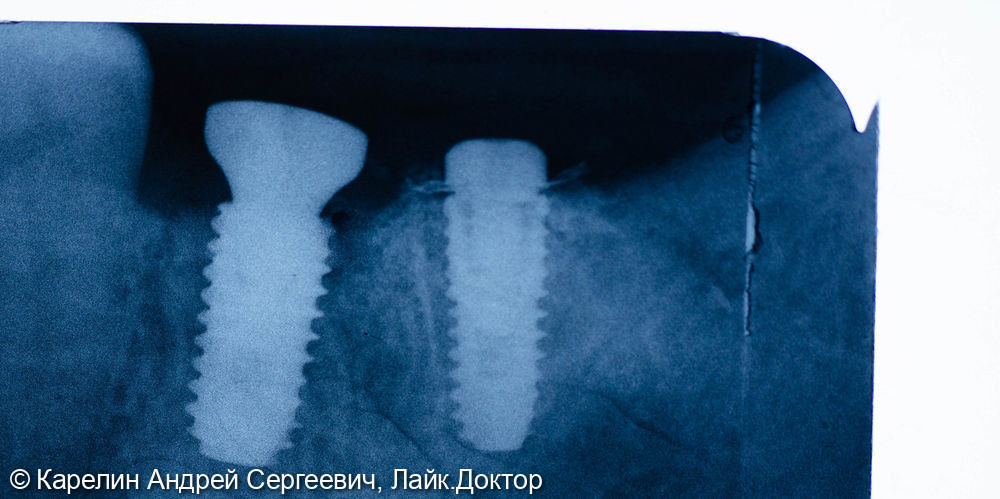 Восстановление отсутствующих зубов в 3 секторе с помощью имплантатов - фото №4