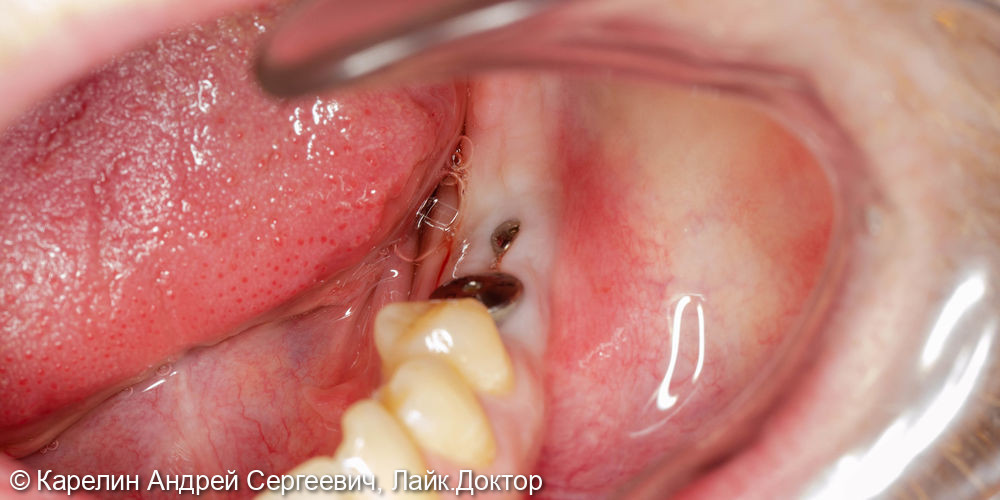 Восстановление отсутствующих зубов в 3 секторе с помощью имплантатов - фото №5
