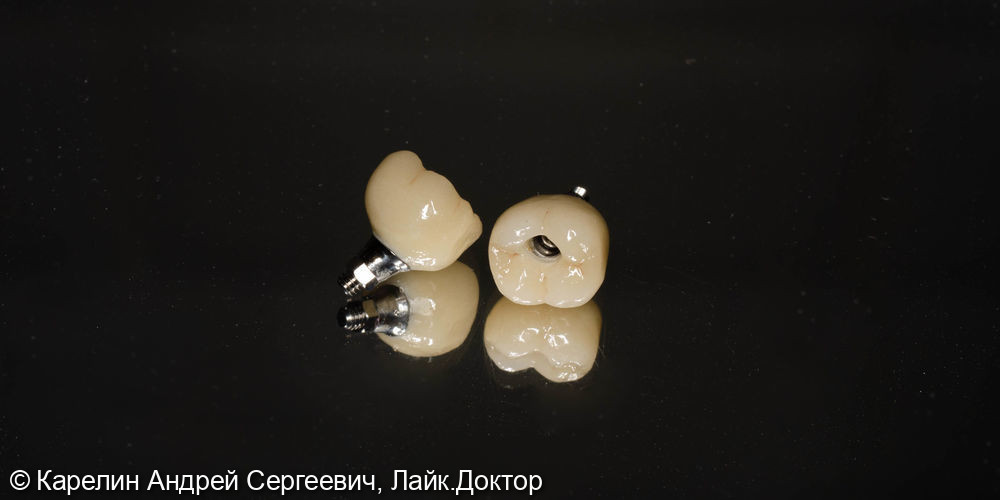 Восстановление отсутствующих зубов в 3 секторе с помощью имплантатов - фото №7