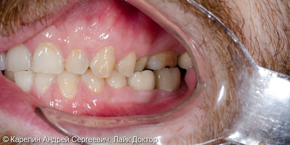 Восстановление отсутствующих зубов в 3 секторе с помощью имплантатов - фото №8