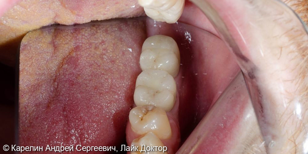 Восстановление отсутствующих зубов в 3 секторе с помощью имплантатов - фото №9
