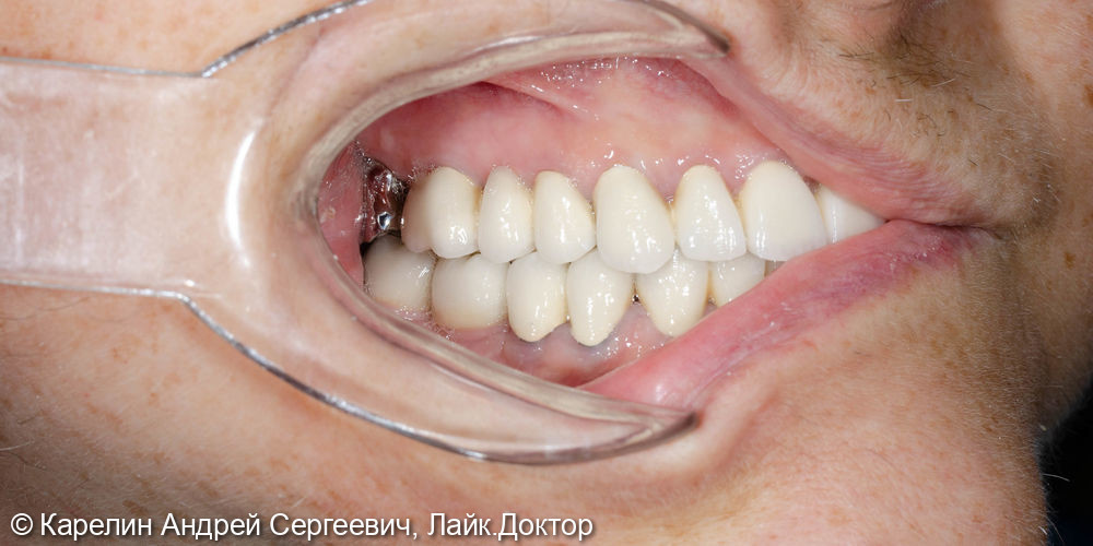 Тотальная реконструкция обеих челюстей с помощью металлокерамических коронок и имплантатов - фото №8
