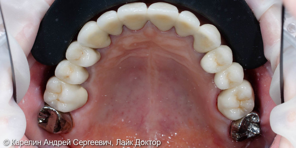 Тотальная реконструкция обеих челюстей с помощью металлокерамических коронок и имплантатов - фото №10