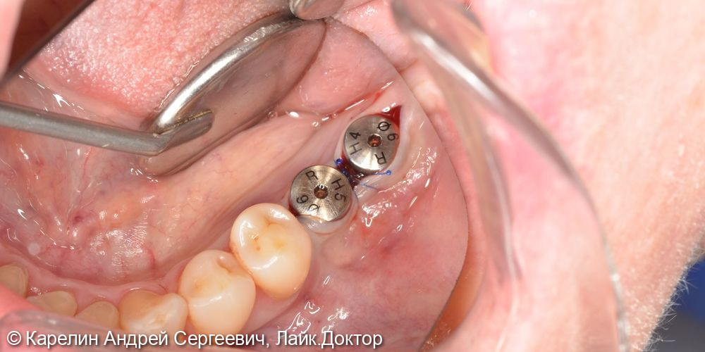 Имплантация в жевательном отделе нижней челюсти и операция по формированию преддверия - фото №8