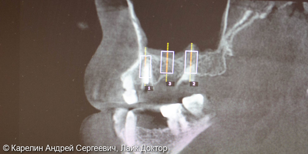 Имплантация в области зубов 2.5,2.6,2.7 с закрытым синуслифтингом - фото №2