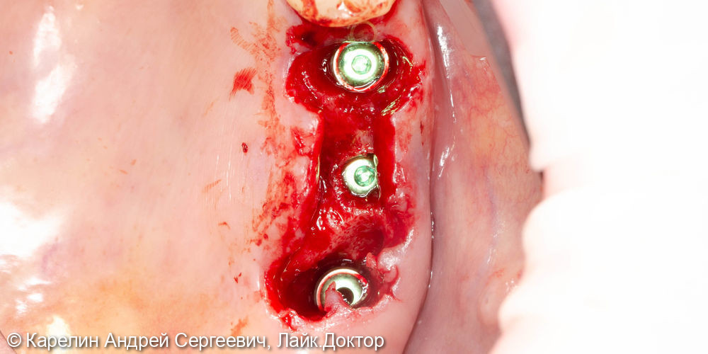 Имплантация в области зубов 2.5,2.6,2.7 с закрытым синуслифтингом - фото №4