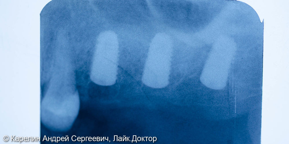 Имплантация в области зубов 2.5,2.6,2.7 с закрытым синуслифтингом - фото №5