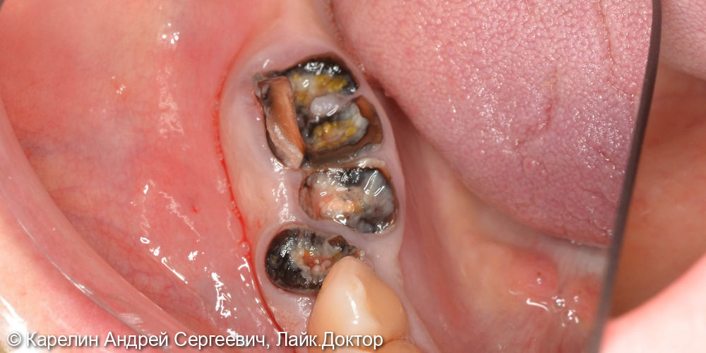 Одномоментная имплантация в области зубов 4.4,4.6,4.7 с костной пластикой - фото №1