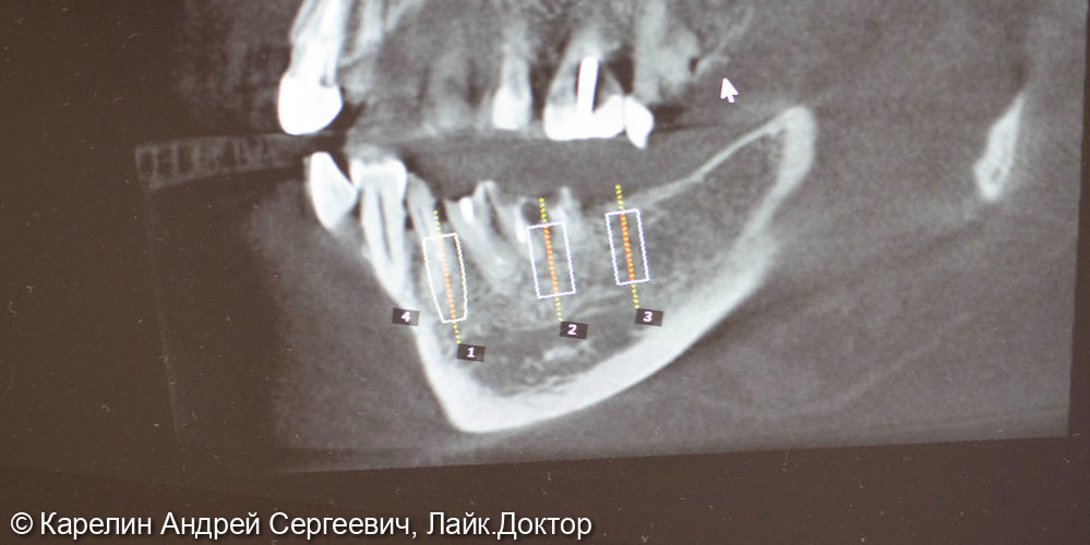 Одномоментная имплантация в области зубов 4.4,4.6,4.7 с костной пластикой - фото №2