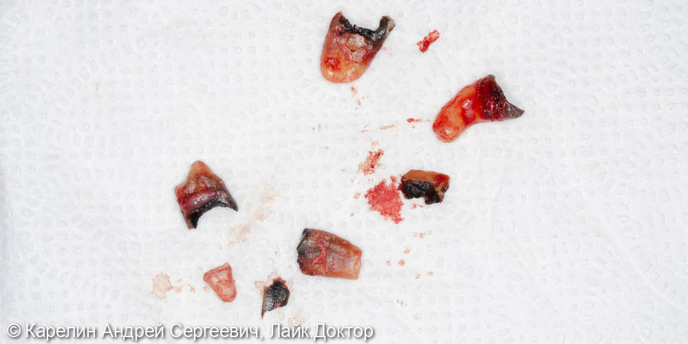 Одномоментная имплантация в области зубов 4.4,4.6,4.7 с костной пластикой - фото №3