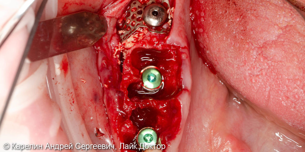 Одномоментная имплантация в области зубов 4.4,4.6,4.7 с костной пластикой - фото №5