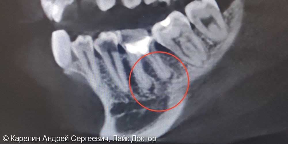 Лечение обострения хронического гранулирующего периодонтита зуба 4.6 - фото №1