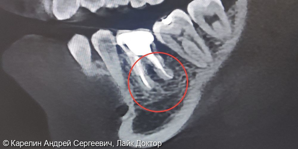 Лечение обострения хронического гранулирующего периодонтита зуба 4.6 - фото №2