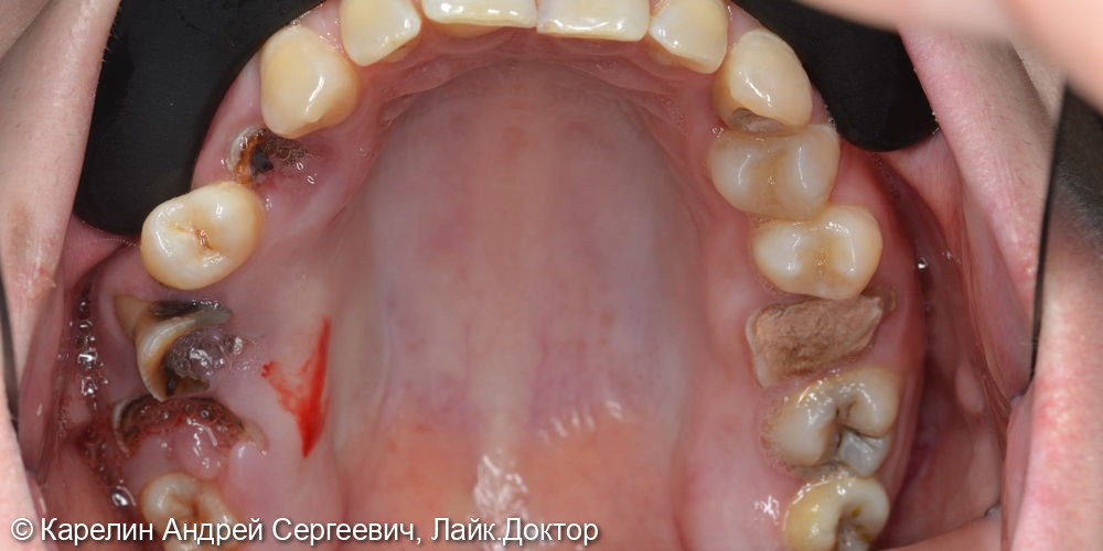 Реабилитация пациентки с помощью ортодонтического лечения, имплантатов и коронок - фото №3