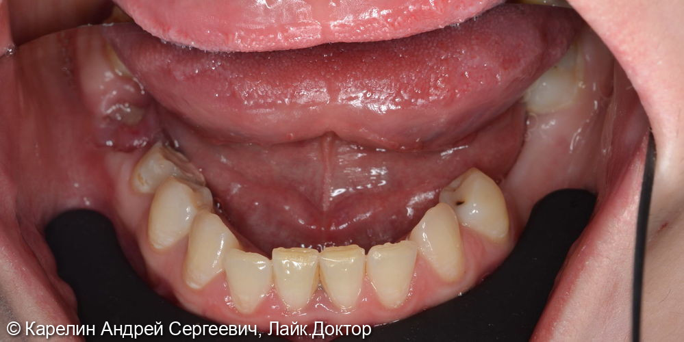 Реабилитация пациентки с помощью ортодонтического лечения, имплантатов и коронок - фото №4