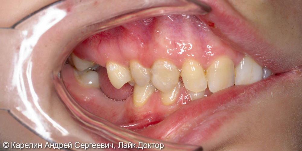 Реабилитация пациентки с помощью ортодонтического лечения, имплантатов и коронок - фото №5