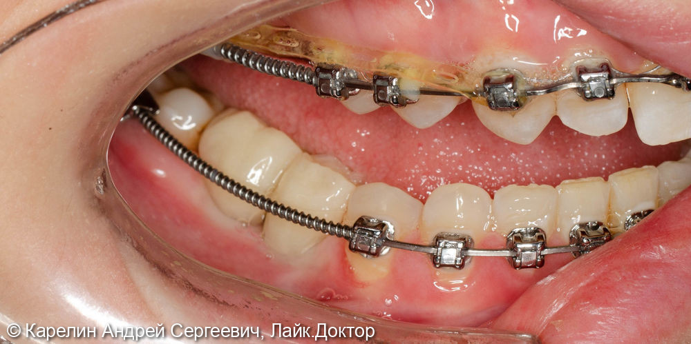 Реабилитация пациентки с помощью ортодонтического лечения, имплантатов и коронок - фото №7