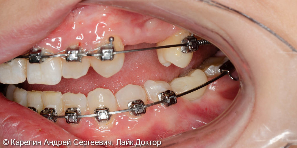 Реабилитация пациентки с помощью ортодонтического лечения, имплантатов и коронок - фото №8