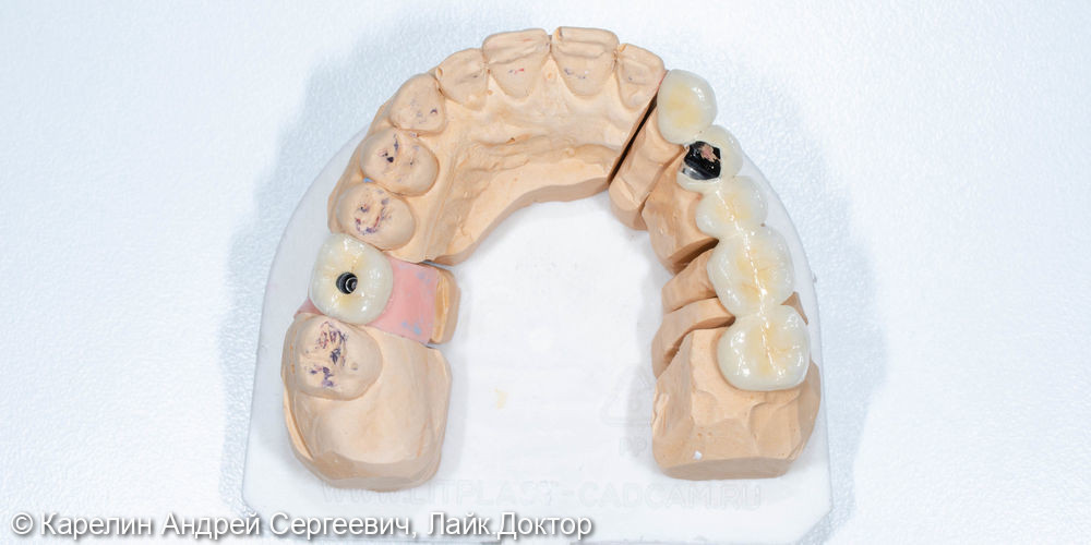 Реабилитация пациентки с помощью ортодонтического лечения, имплантатов и коронок - фото №9