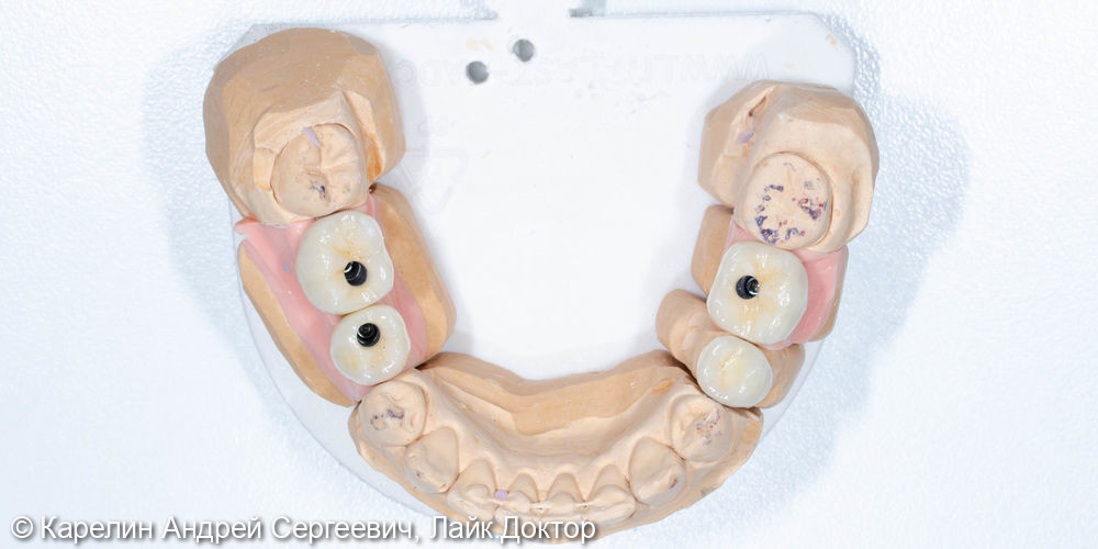 Реабилитация пациентки с помощью ортодонтического лечения, имплантатов и коронок - фото №10