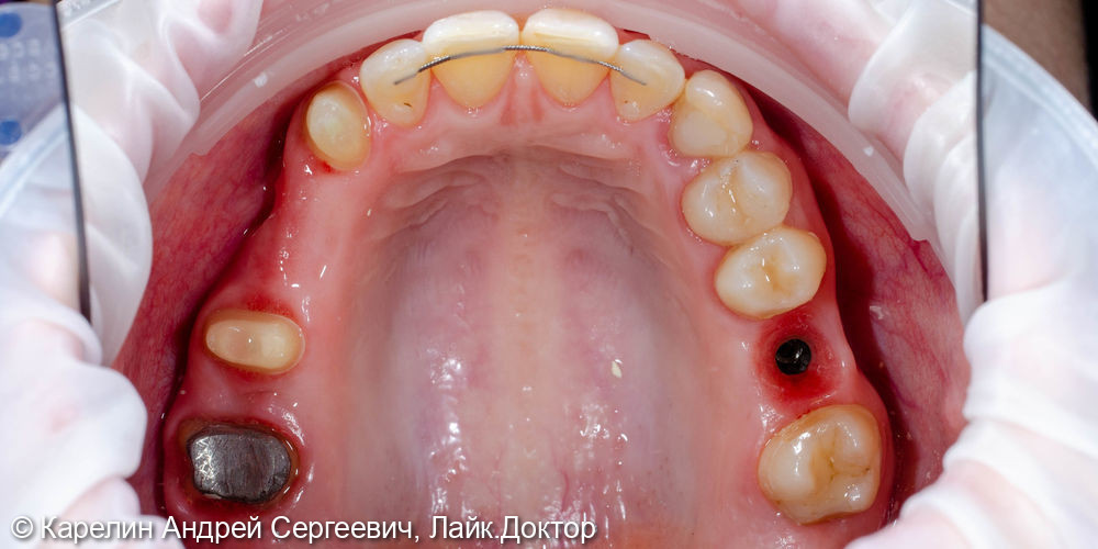 Реабилитация пациентки с помощью ортодонтического лечения, имплантатов и коронок - фото №11