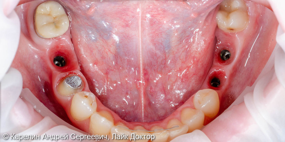 Реабилитация пациентки с помощью ортодонтического лечения, имплантатов и коронок - фото №12