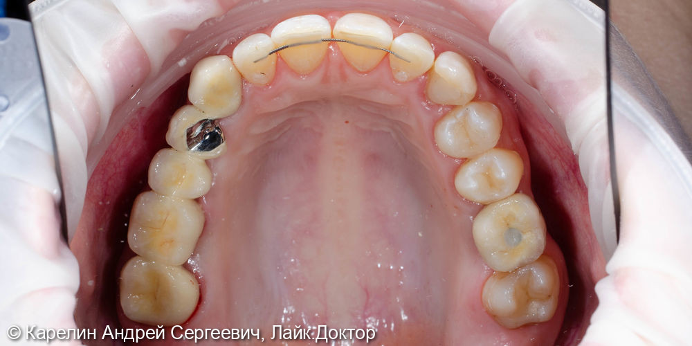 Реабилитация пациентки с помощью ортодонтического лечения, имплантатов и коронок - фото №13
