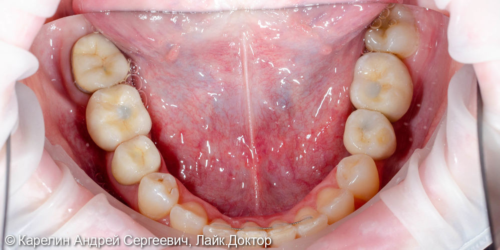 Реабилитация пациентки с помощью ортодонтического лечения, имплантатов и коронок - фото №14