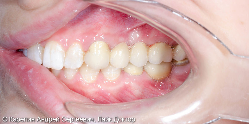 Реабилитация пациентки с помощью ортодонтического лечения, имплантатов и коронок - фото №16