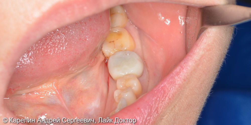 Перелечивание зубы 3.6 с помощью литой вкладки и коронки на основе диоксида циркония - фото №1