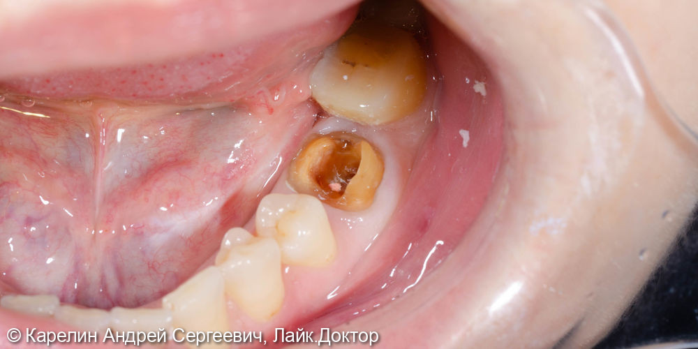 Перелечивание зубы 3.6 с помощью литой вкладки и коронки на основе диоксида циркония - фото №2