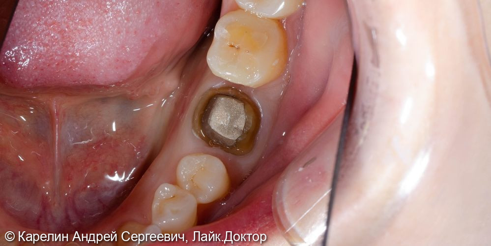 Перелечивание зубы 3.6 с помощью литой вкладки и коронки на основе диоксида циркония - фото №4