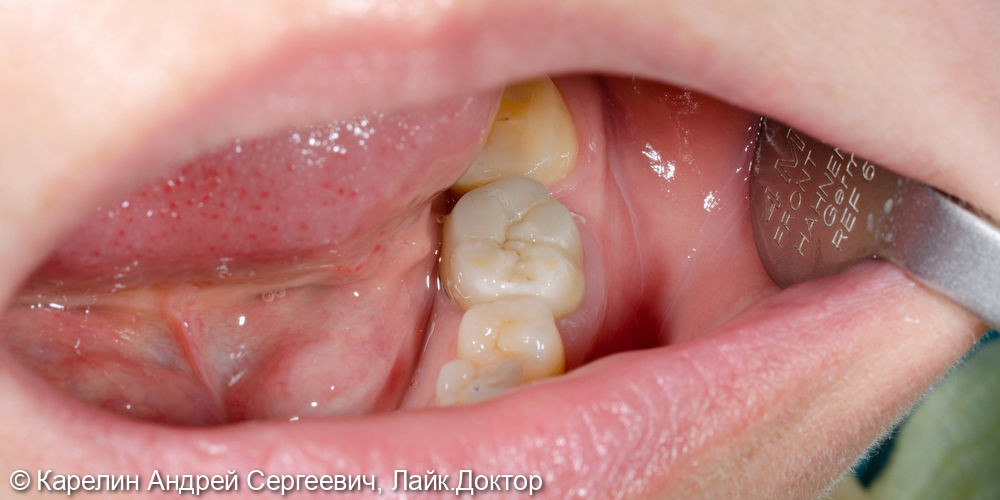 Перелечивание зубы 3.6 с помощью литой вкладки и коронки на основе диоксида циркония - фото №5