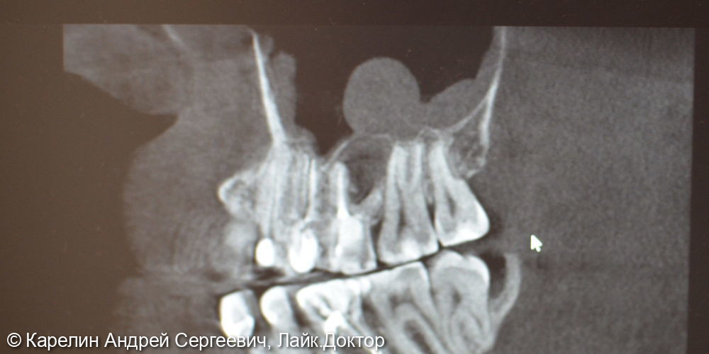 Атравматическое удаление зуба 1.6 и цистэктомия - фото №1