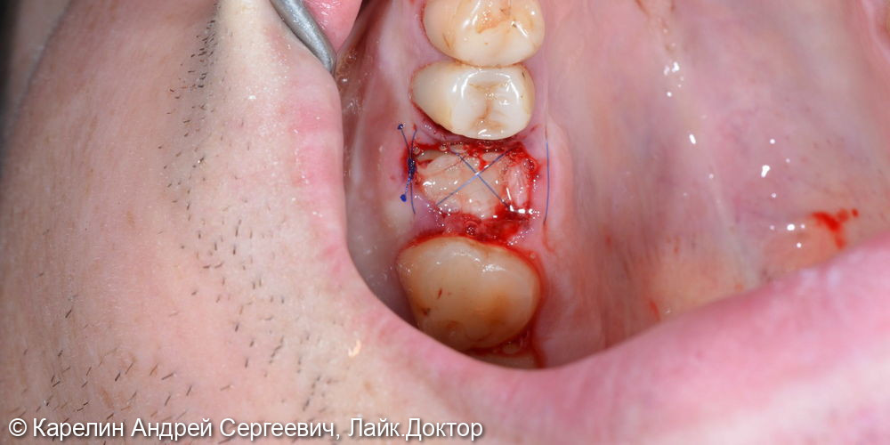 Атравматическое удаление зуба 1.6 и цистэктомия - фото №4