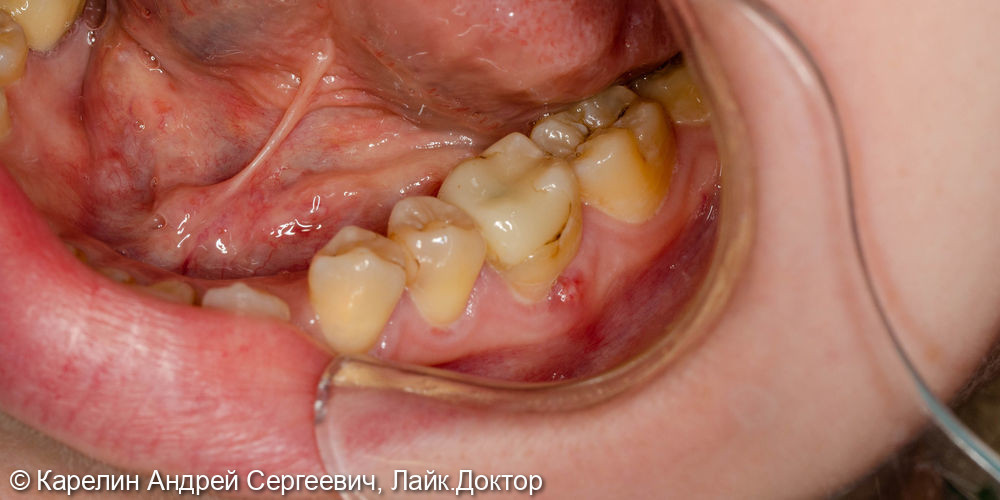 Все этапы удаления, имплантации и протезирования зуба 3.6 - фото №1
