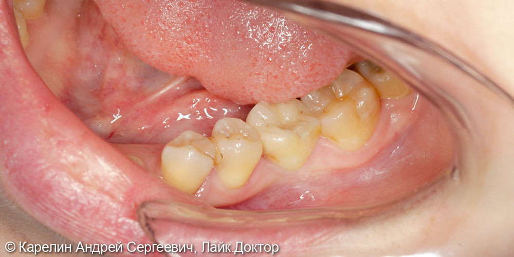 Все этапы удаления, имплантации и протезирования зуба 3.6 - фото №12
