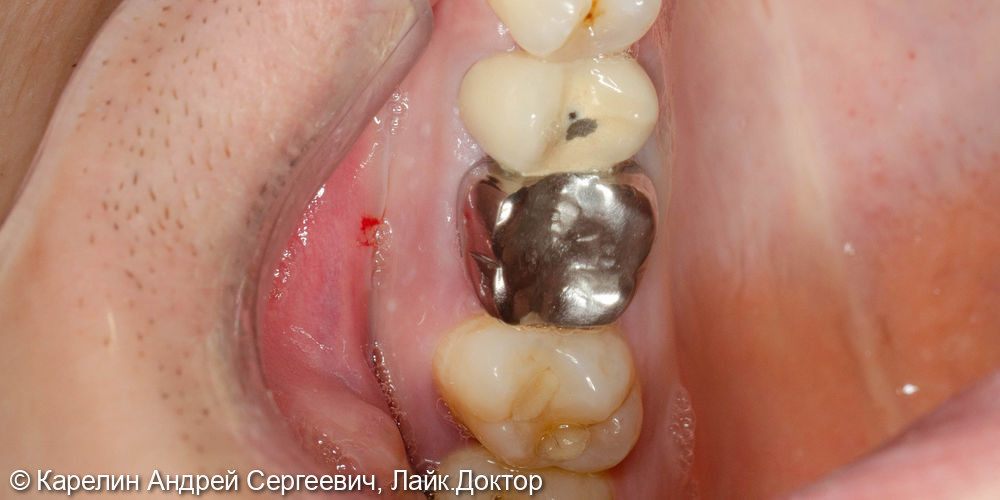 Атравматическое удаление зуба 1.6 под имплантацию - фото №1