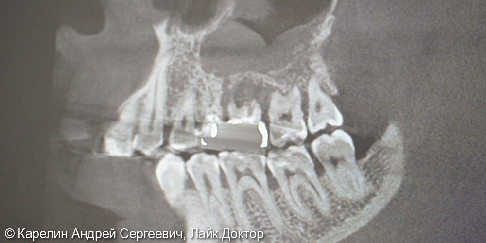 Атравматическое удаление зуба 1.6 под имплантацию - фото №2