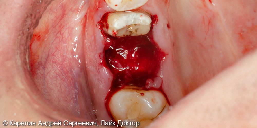 Атравматическое удаление зуба 1.6 под имплантацию - фото №4
