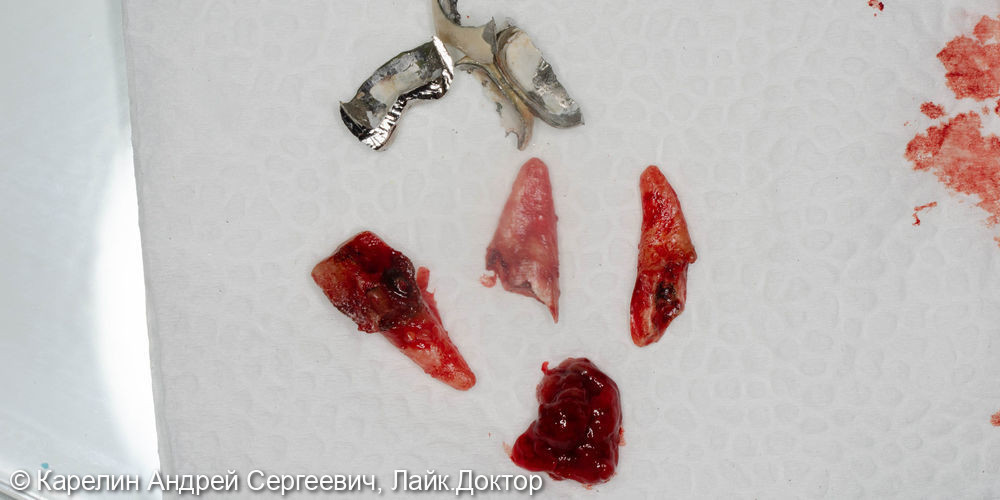 Атравматическое удаление зуба 1.6 под имплантацию - фото №5