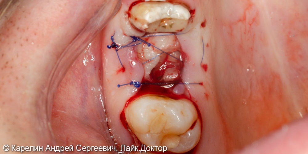 Атравматическое удаление зуба 1.6 под имплантацию - фото №6