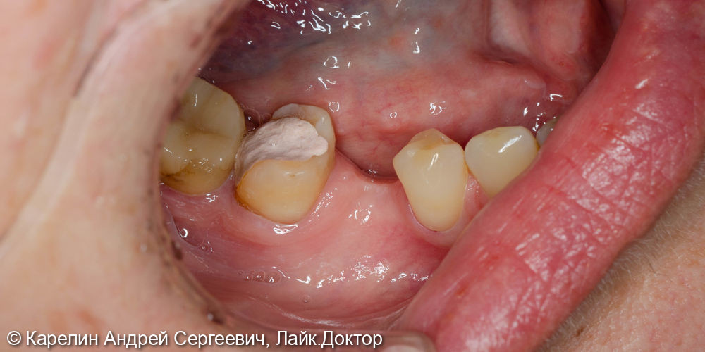 Удаление и имплантация в области зубов 2.4,4.5 и 4.6 - фото №1