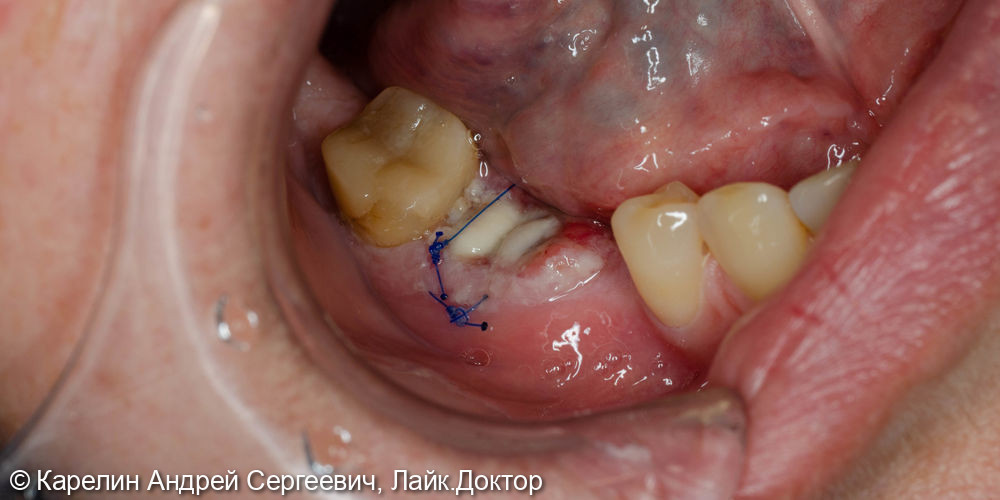Удаление и имплантация в области зубов 2.4,4.5 и 4.6 - фото №2