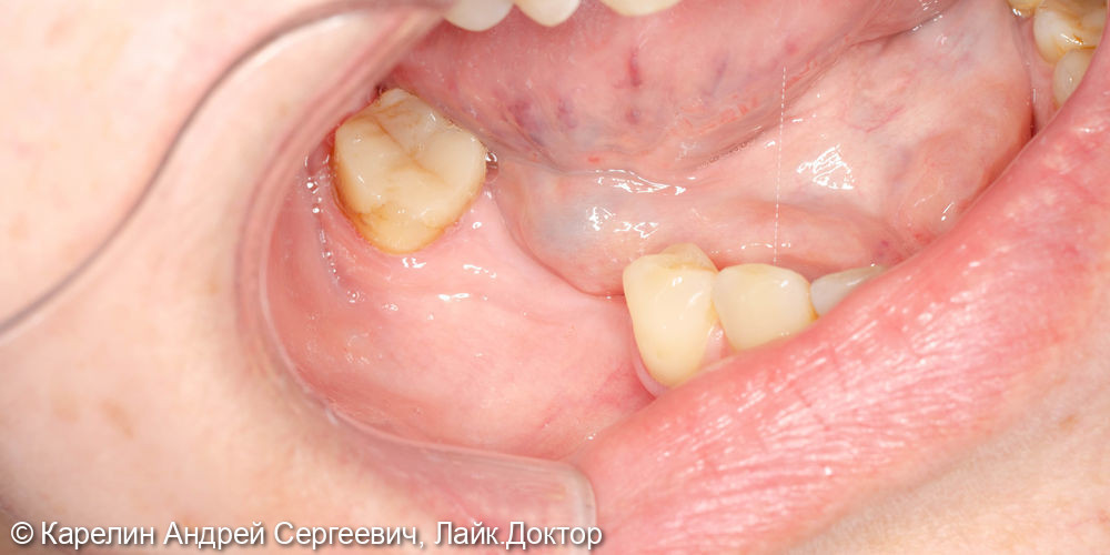 Удаление и имплантация в области зубов 2.4,4.5 и 4.6 - фото №4