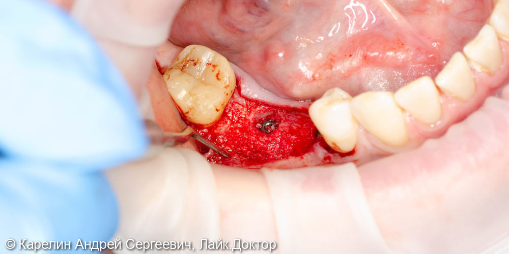 Удаление и имплантация в области зубов 2.4,4.5 и 4.6 - фото №5
